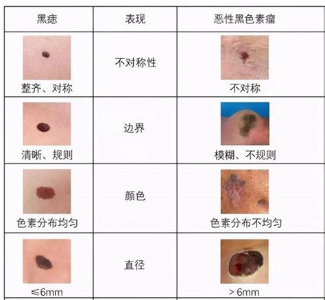 黑痣的形成|色素痣